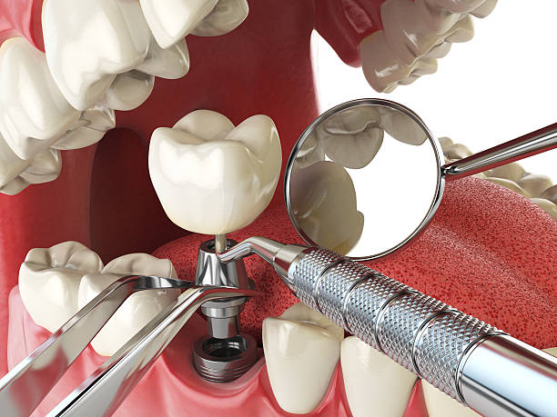 Best Emergency Dentist for Lost Fillings or Crowns in Hicksville, NY